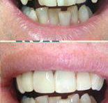 Your Dentist Gunnedah - Insurance Yet